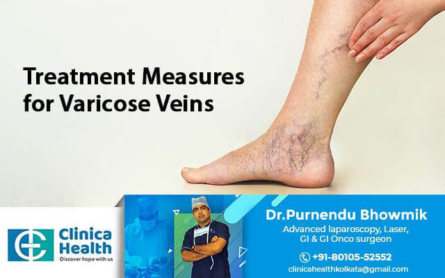 Treatment Measures for Varicose Veins – Surgeon Explains