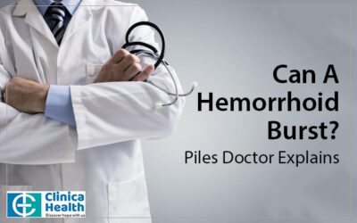 Can A Hemorrhoid Burst?-Piles Doctor Explains