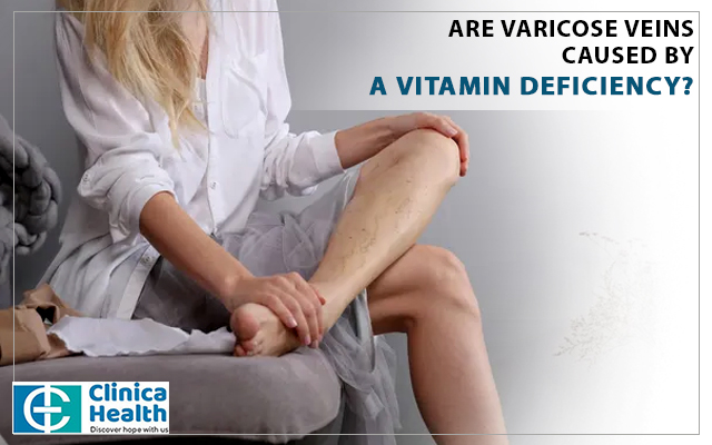 varicose vein treatment